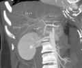 MDCT image. Arterial anatomy contraindicated for liver donation.