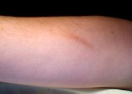 Very-minor-scar.jpg