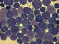 bone marrow smear (large magnification) from a patient with acute lymphoblastic leukemia