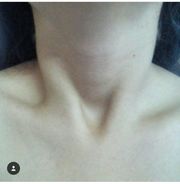  الشق الوداجي (الثلمة فوق القص).