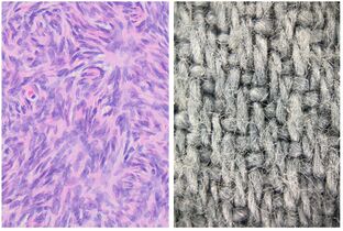 Woven or storiform: Elongated cells or nuclei wherein small bundles are aligned in an otherwise haphazard pattern.