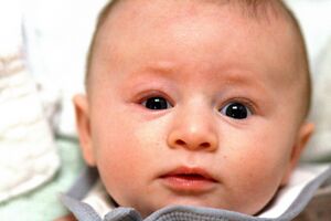 Infant with blepharitis on the right side.jpg