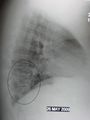 A lateral CXR showing right lower lobe pneumonia