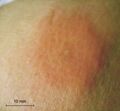 A bee sting 1 day after