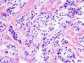 Pancreatic insulinoma (1).JPG