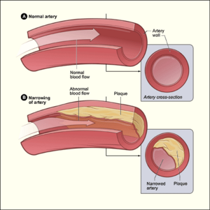 Atherosclerosis diagram.png