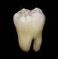 Lower wisdom tooth.jpg