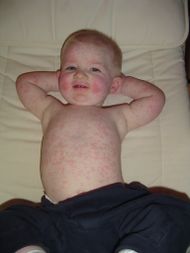 Fifth disease.jpg