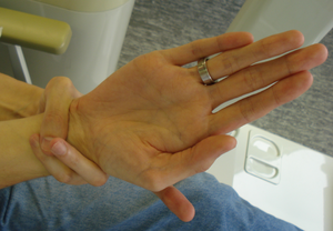 Marfan wrist.tiff