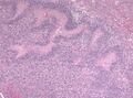 Pseudopalisading seen around necrosis in glioblastoma