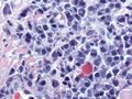 Atypical plasma cell infiltrate with both Russell (cytoplasmic) and Dutcher (nuclear) bodies (H&E, 50x).