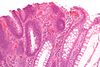 Tubular adenoma 2 high mag.jpg