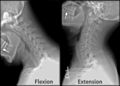 X-ray of cervical spine in flexion and extension.