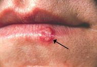 Herpes(PHIL 1573 lores).jpg