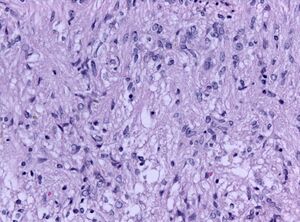 Pituicytoma.jpg