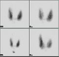 Thyroid scan with iodine-123 for evaluation of hyperthyroidism.