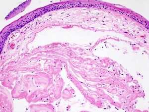 Laryngeal nodule (1).jpg