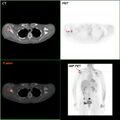 F-18 FDG PET/CT: ورم خبيث من سرطان الثدي في الكتف الأيمن.