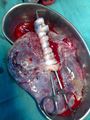 Picture of freshly delivered placenta and umbillical cord wrapped around Kelly clamps