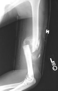 Communitive midshaft humeral fracture callus.jpg