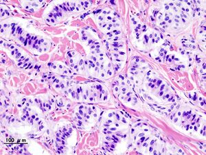 Pancreatic insulinoma (2).JPG