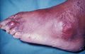 Tophi of the toe, and over the external maleolus.